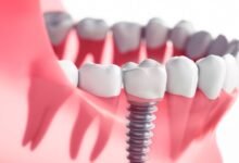 Navigating the Healing Journey with Dental Implants