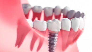 Navigating the Healing Journey with Dental Implants